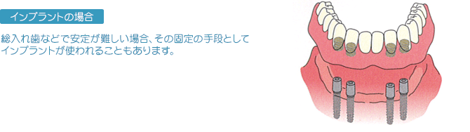 インプラントの場合総入れ歯などで安定が難しい場合、その固定の手段としてインプラントが使われることもあります。