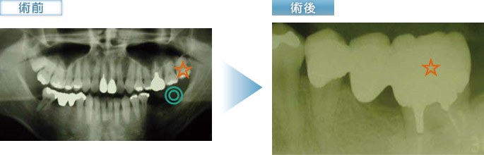 歯牙移植の症例①の術前、術後写真